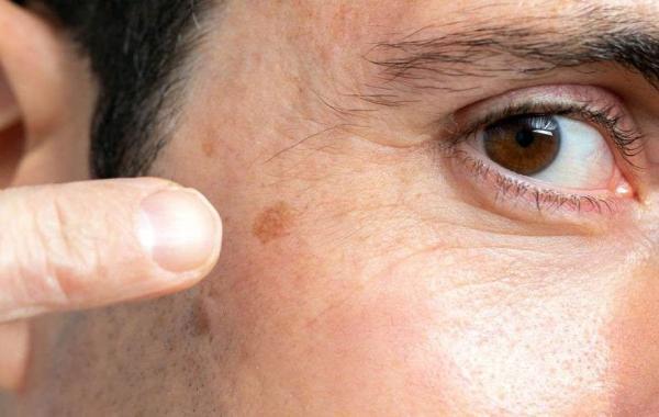 7 راه چاره برای خلاص شدن از شر لکه های پوستی ناشی از افزایش سن