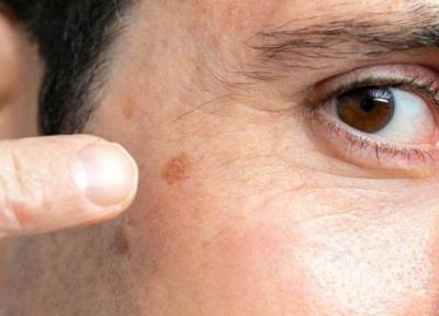 7 راه چاره برای خلاص شدن از شر لکه های پوستی ناشی از افزایش سن
